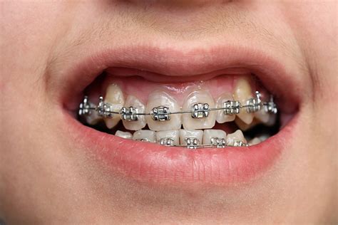 Free Dental Braces? Can My Child Get Them? - Ridgway Dental | Wimbledon::Ridgway Dental | Wimbledon