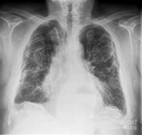 Asbestosis, X-ray Photograph by Science Photo Library