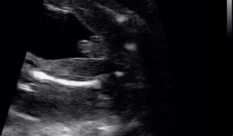 Early Gender Ultrasound