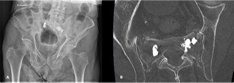 A Anteroposterior pelvic radiograph showing bilateral sacroplasty. B... | Download Scientific ...