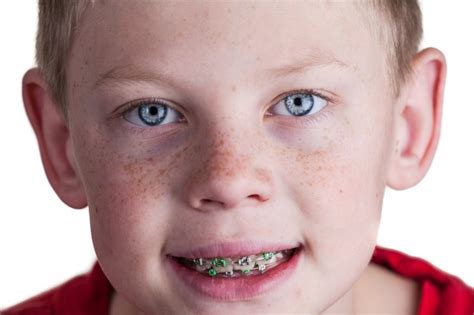 What Are the Different Types if Braces? | New England Kids