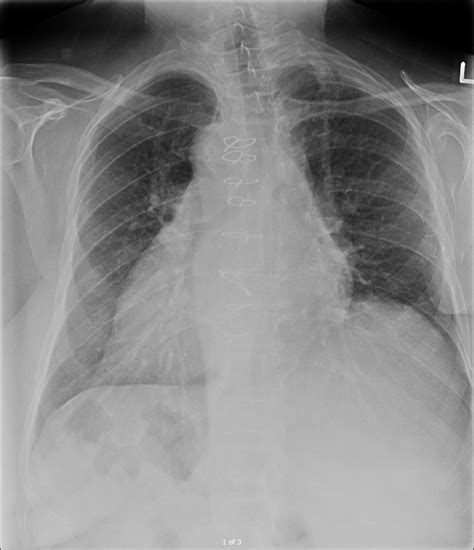 Dextrocardia - Cardio Guide