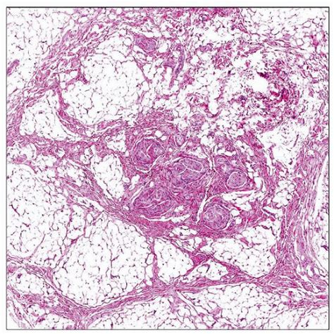 Fibrolipomatous Hamartoma of Nerve | Basicmedical Key