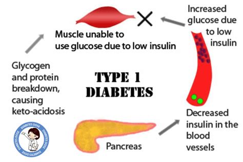 Type 1 Diabetes Causes, Signs & Symptoms, Effects, Prevention ...