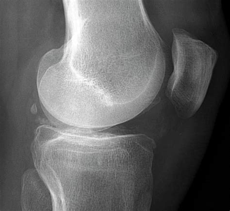 Calcification In The Knee Photograph by Zephyr - Pixels