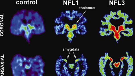 Punch-drunk syndrome: CTE found in former NRL players | The Australian