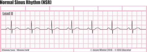 ECG Educator Blog : Normal Sinus Rhythm