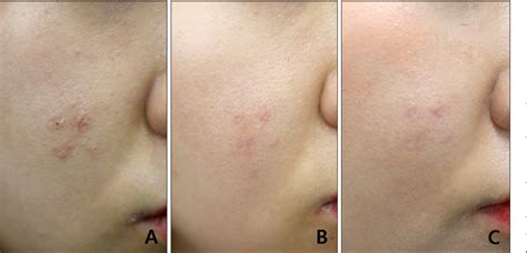 Figure 1 from Treatment of Nevus Sebaceous with Carbon Dioxide Laser ...