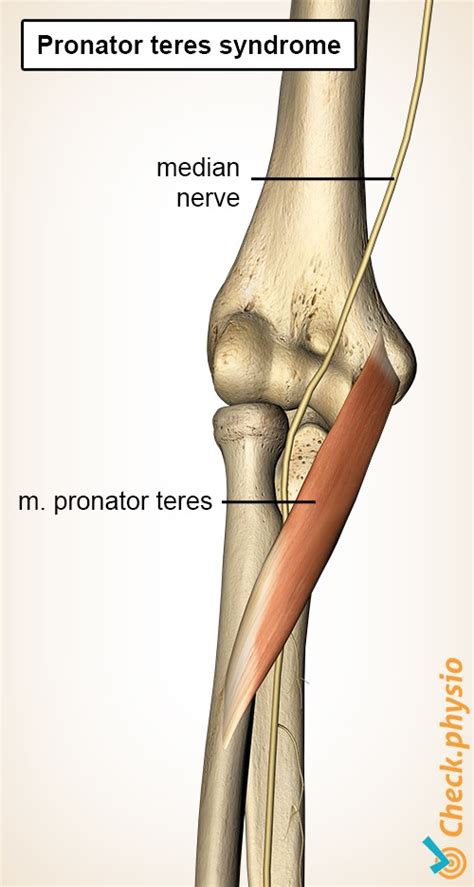 Pronator teres syndrome | Physio Check