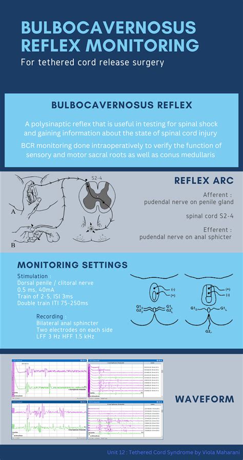 Info of the Day: "BCR-Bulbocavernosus Reflex Monitoring"