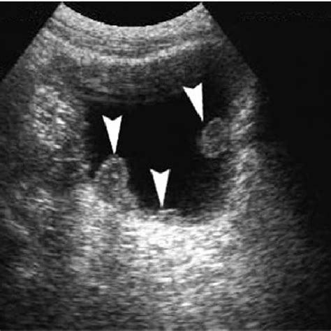 Diverticulum Of Bladder Ultrasound