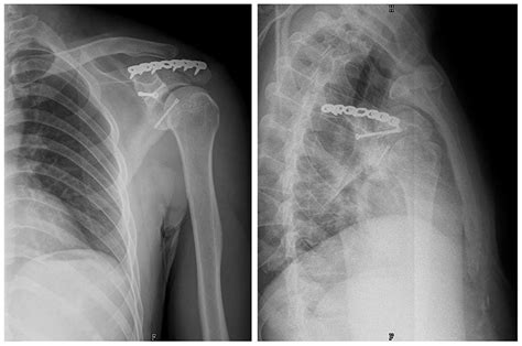 Acromial approach for treating glenoid fractures: A report of two cases and a literature review