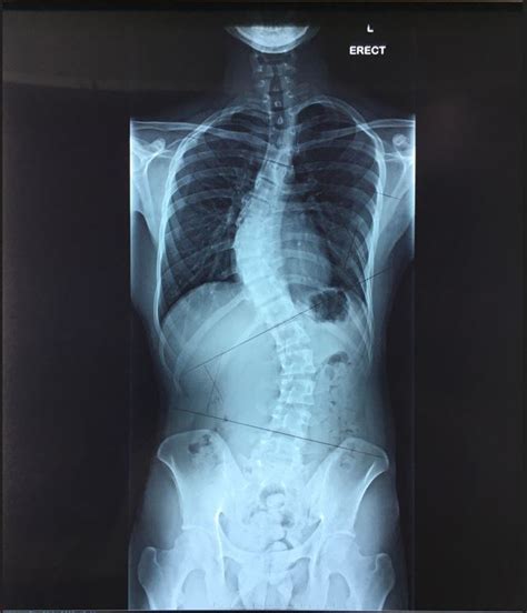 Lumbar Scoliosis X Ray