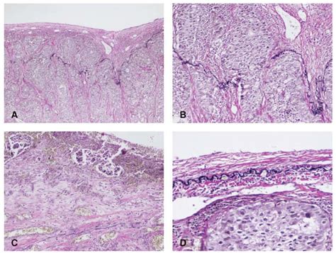 Visceral Pleura Histology