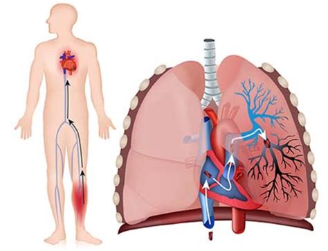 Tromboembolismo pulmonar - Fundación Española del Corazón