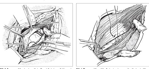 Figure 4 from The Shouldice technique: a canon in hernia repair ...