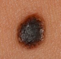 Cancerous Black Moles