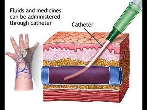 IV Cannulation Technique - YouTube