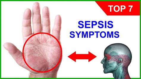 Sepsis Symptoms – Top 7 Signs of Sepsis and Stages of this Septic Shock ... | Sepsis symptoms ...