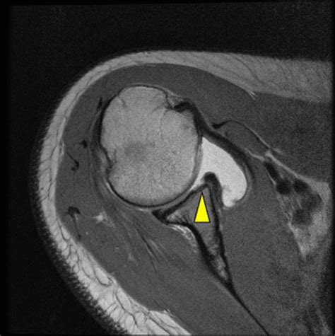 Acute Versus Delayed Magnetic Resonance Imaging and Associated Abnormalities in Traumatic ...