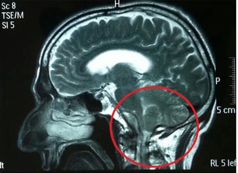 Cerebellar Tonsil Herniation