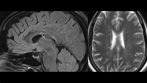 Corpus Callosum Lesions - The Neurology Hub