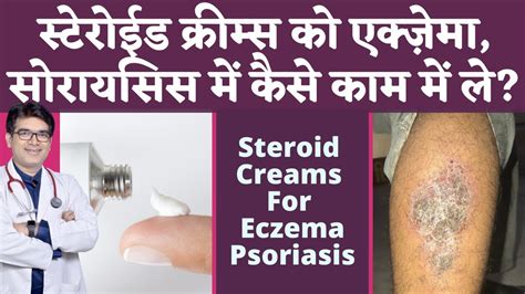 How To Use Steroid Creams For Eczema, Psoriasis Safely | स्टेरोईड क्रीम्स का उपयोग कैसे करे ...