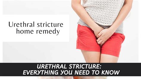 Urethral stricture home remedy | Urethral stricture: Everything you need to know - YouTube