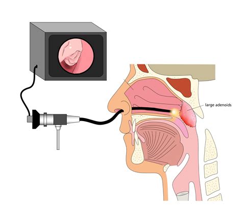 Flexible nasoendoscopy in children — ent4kids