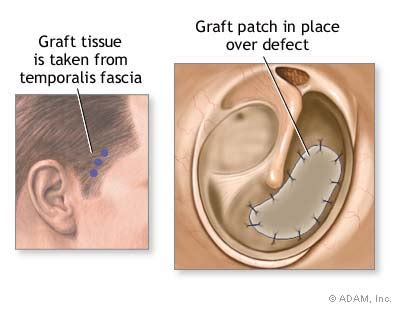 The New York Times > Health > Slide Show > Eardrum Repair > Slide 3 of 5