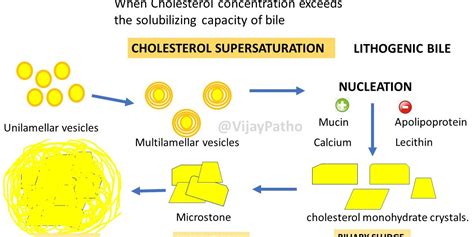 Cholesterol Gallstones