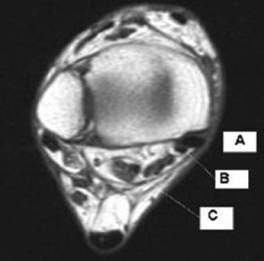 Flexor Hallucis Longus Tendon Injury Imaging: Practice Essentials ...