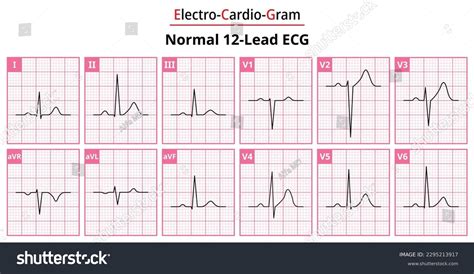 Normal 12 Lead Ecg Labeled