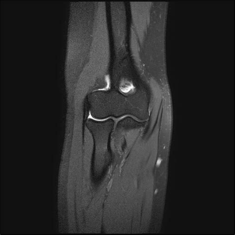 Elbow Mri Anatomy