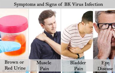 BK Virus Infection - Risk Factors, Symptoms, Signs, Diagnosis, Treatment, Prognosis