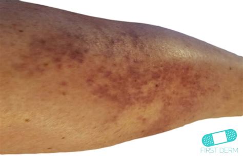 Vasculitis (Leukocytoclastic Vasculitis) - Online Dermatology