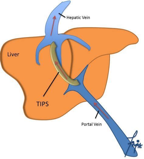 TIPS (Shunt): Transjugular Intrahepatic Portosystemic Shunt (TIPS) » TIPS (Shunt) » Division of ...