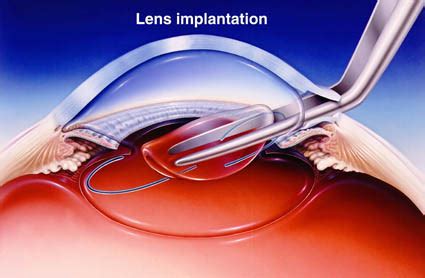 Best Lens Options For Cataract Surgery in 2024- EyeMantra