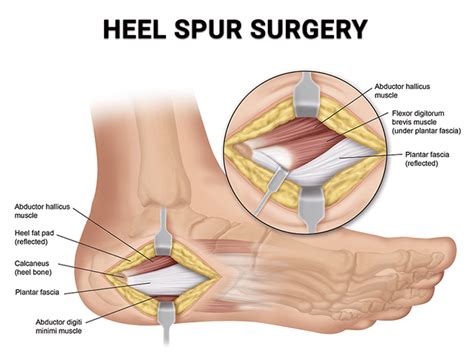 Bone Spur Heel Treatment Online | bellvalefarms.com