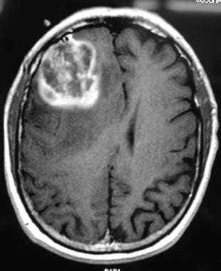 T1加权轴向钆增强MRI demonstr