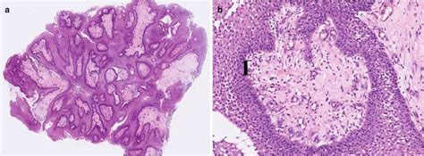 Classification for Craniopharyngioma and Histopathological Aspect | Neupsy Key