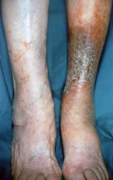 Stasis Dermatitis and Leg Ulcers | Better Living | Wiki Itchy Mind