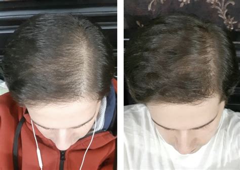 Rosemary Oil Before And After: Hair Loss Results - Wimpole Clinic