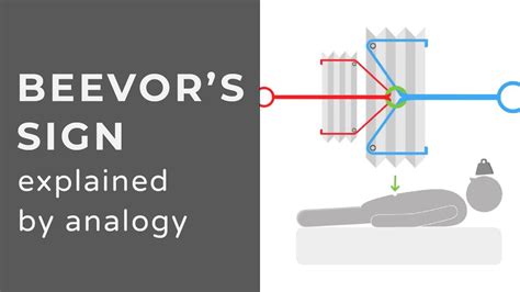 Beevor's Sign | Lower Thoracic Cord Lesions & Myopathies | Animation | Explained Conceptually ...