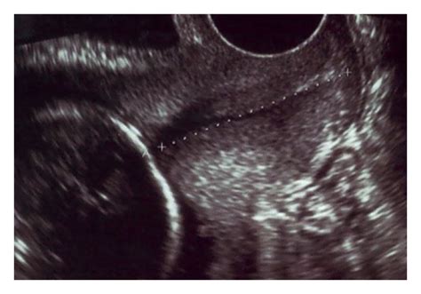 Transvaginal ultrasound image of the uterine cervix. | Download ...