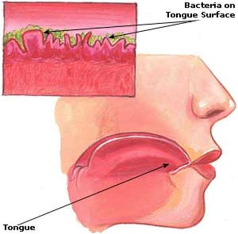 Home Remedies for Halitosis: Causes, Symptoms, Treatment & Diet