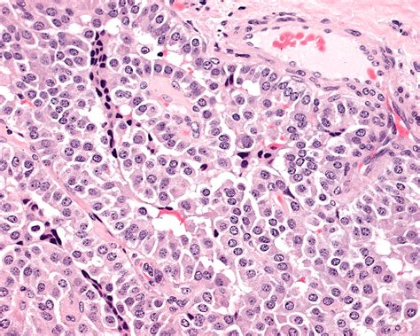 Pathology Outlines - Medullary thyroid carcinoma