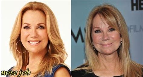 Kathie Lee Gifford before and after plasticnose job 01 – Celebrity plastic surgery online