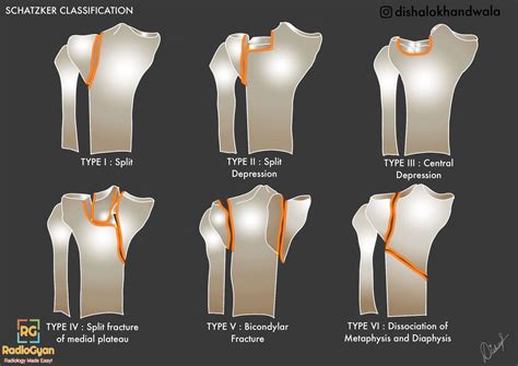 Schatzker Classification of Tibial Plateau Fractures - RadioGyan