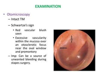 Otosclerosis | PPT